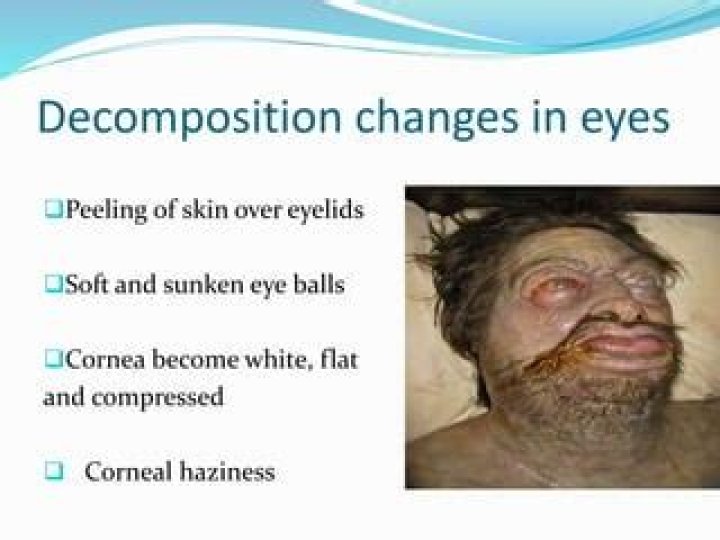 Can a living person decompose?