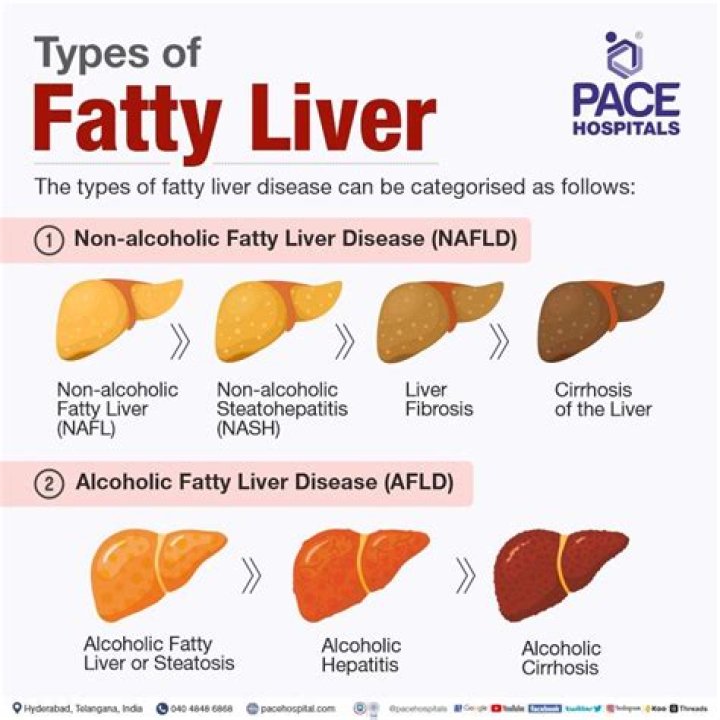 What are the stages of fatty liver?