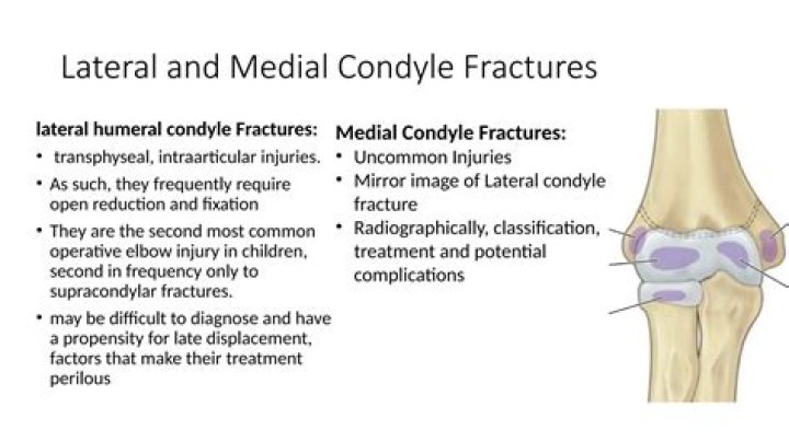 What attaches to the medial condyle of the femur?