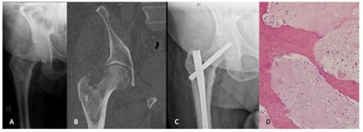 What is an unspecified pathological fracture?