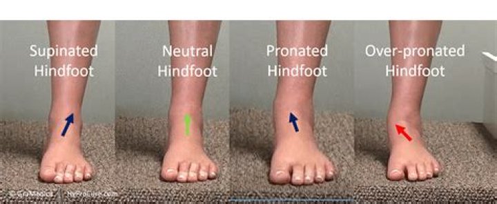 What is mild hindfoot valgus?