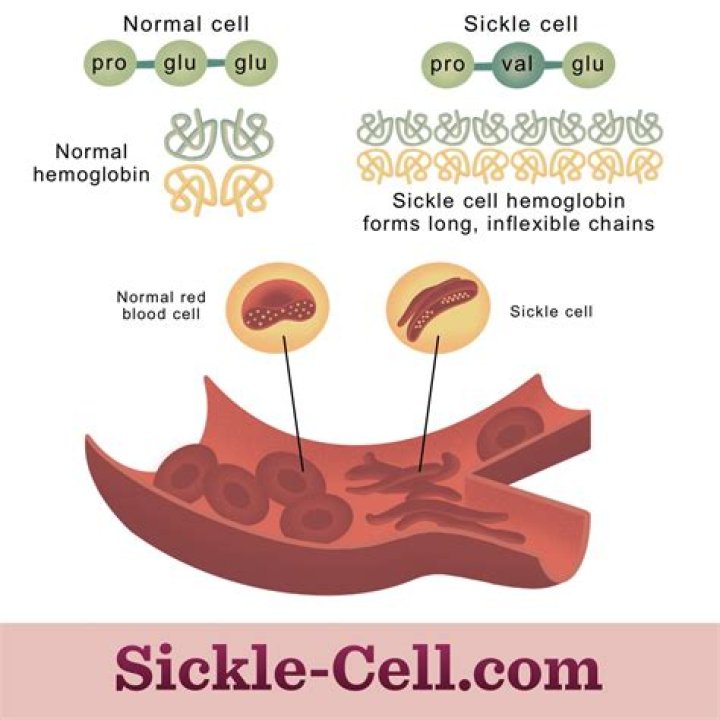 Where is sickle cell allele most frequent?