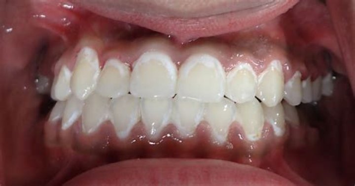 Will I have white spots after braces?